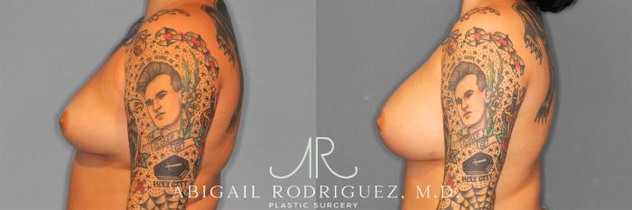 Before & After Breast Augmentation Case 258127 View 6 View in Houston, TX