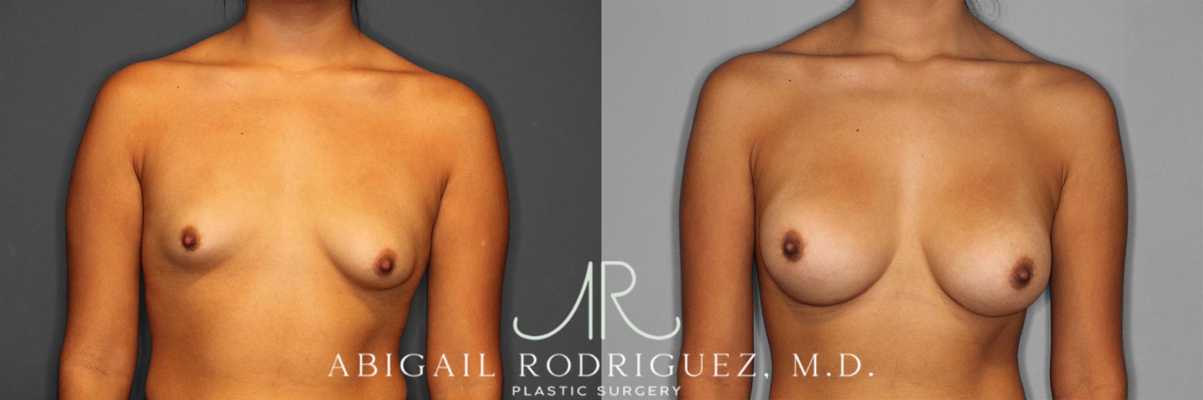 Before & After Breast Augmentation Case 258362 View 1 View in Houston, TX