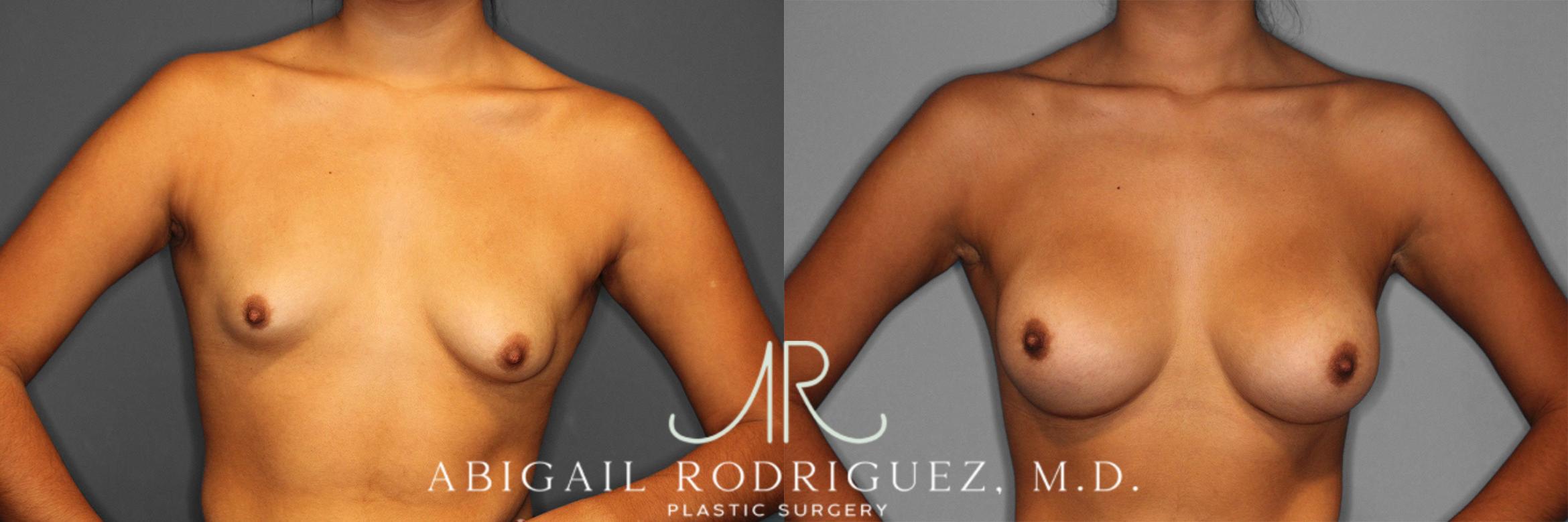 Before & After Breast Augmentation Case 258362 View 2 View in Houston, TX