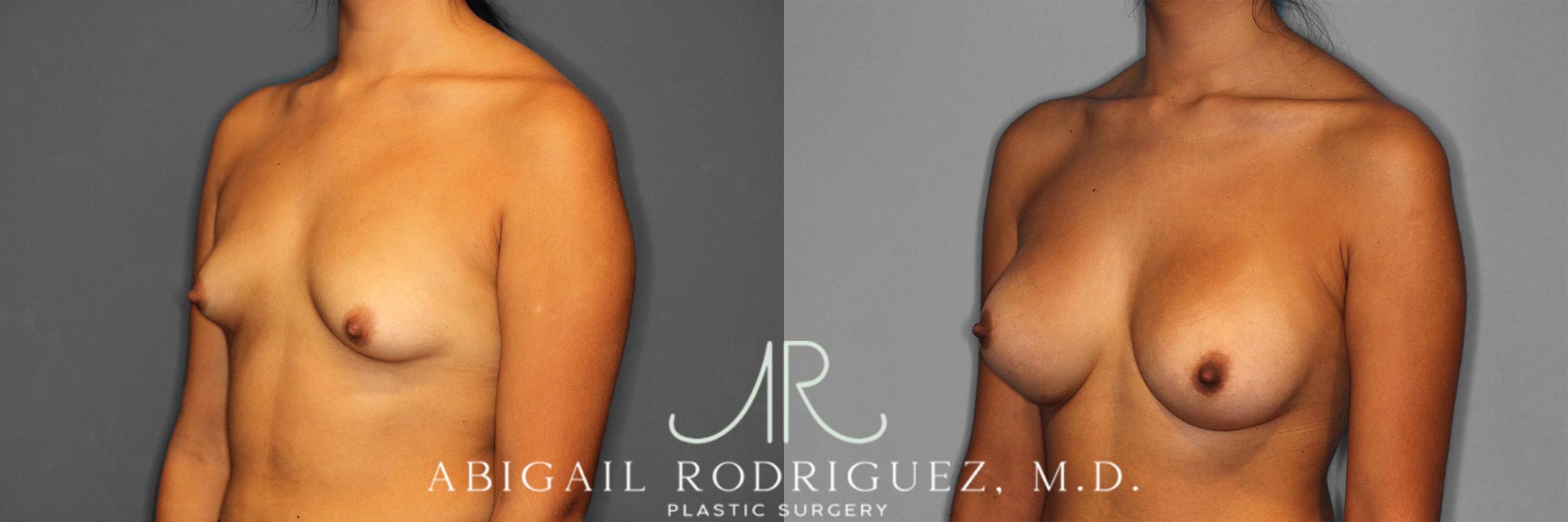 Before & After Breast Augmentation Case 258362 View 3 View in Houston, TX