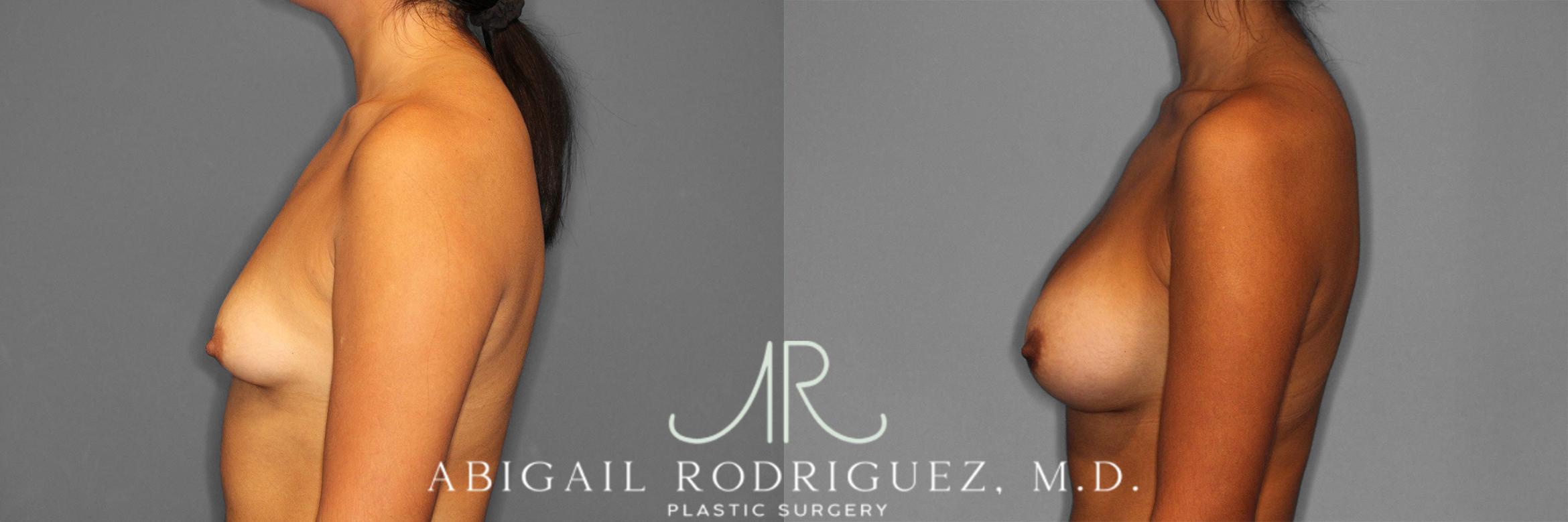 Before & After Breast Augmentation Case 258362 View 4 View in Houston, TX