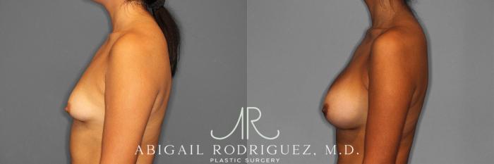 Before & After Breast Augmentation Case 258362 View 4 View in Houston, TX