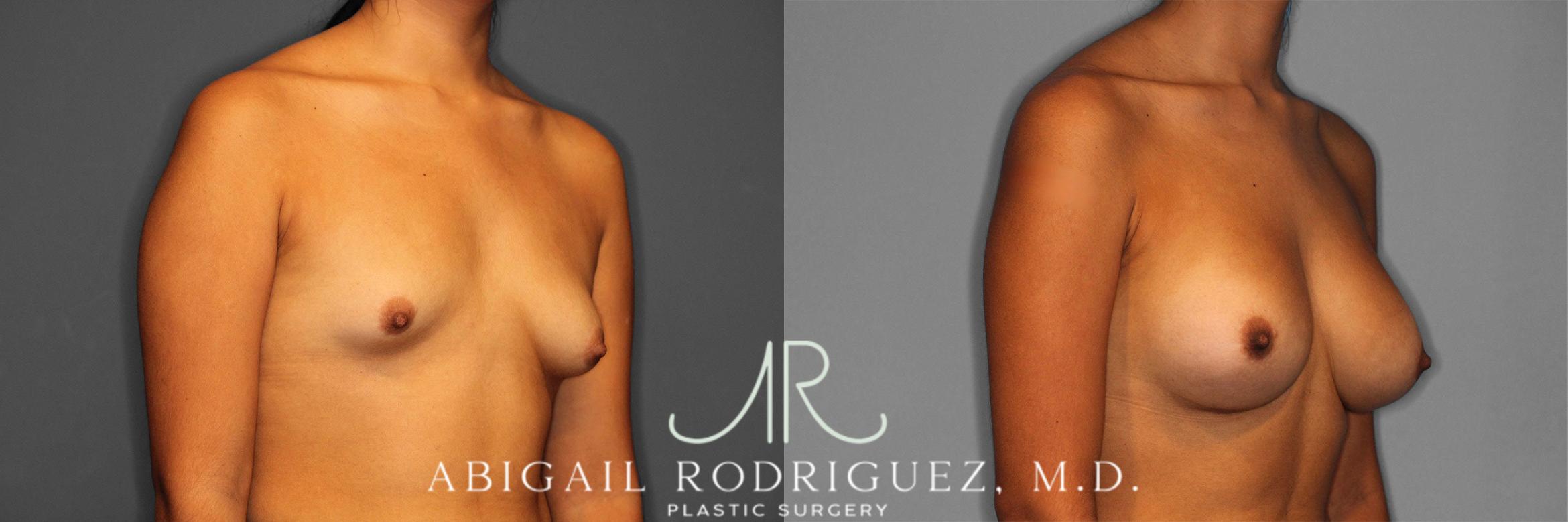 Before & After Breast Augmentation Case 258362 View 5 View in Houston, TX