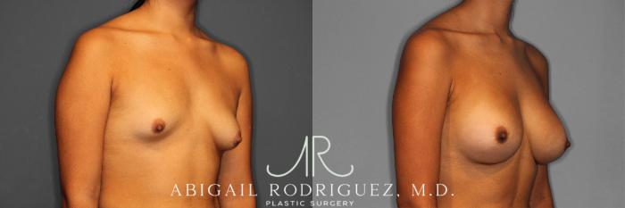 Before & After Breast Augmentation Case 258362 View 5 View in Houston, TX