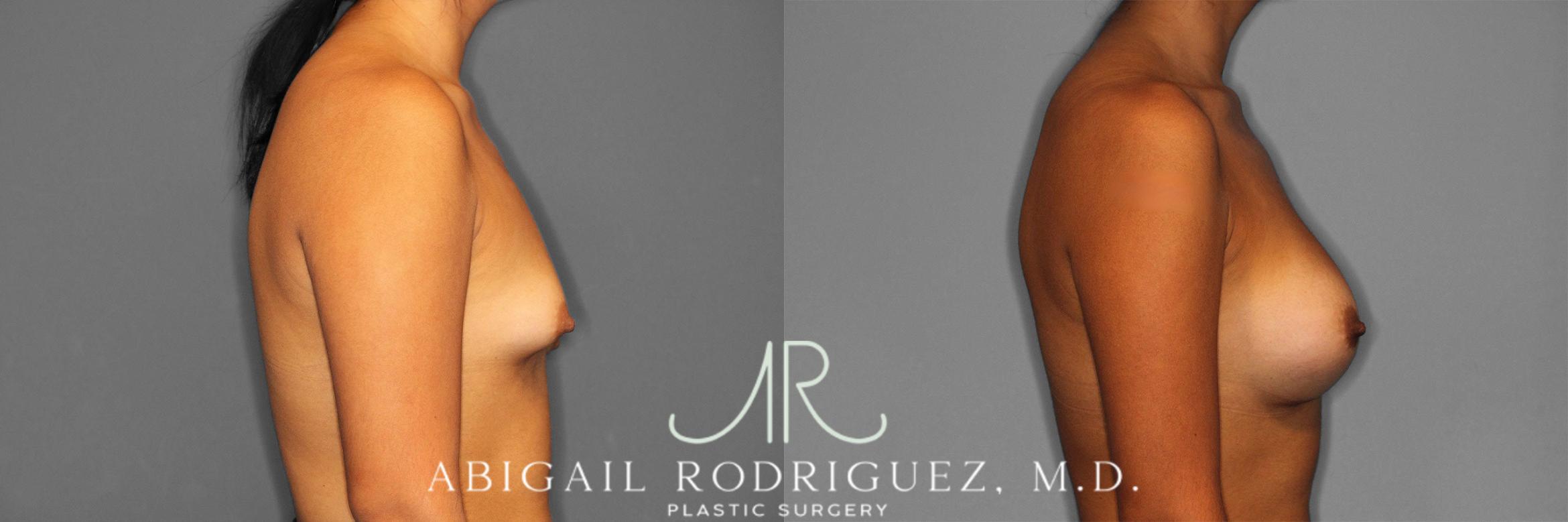 Before & After Breast Augmentation Case 258362 View 6 View in Houston, TX