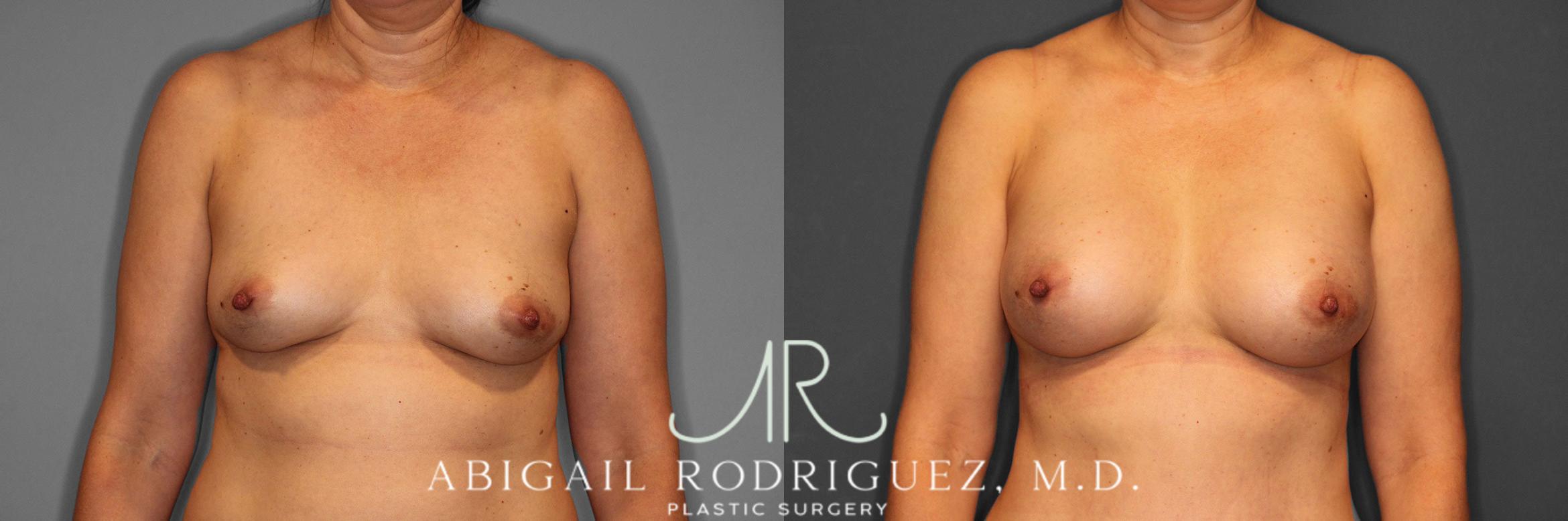 Before & After Breast Augmentation Case 258508 View 1 View in Houston, TX