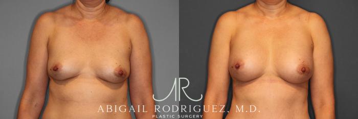 Before & After Breast Augmentation Case 258508 View 1 View in Houston, TX