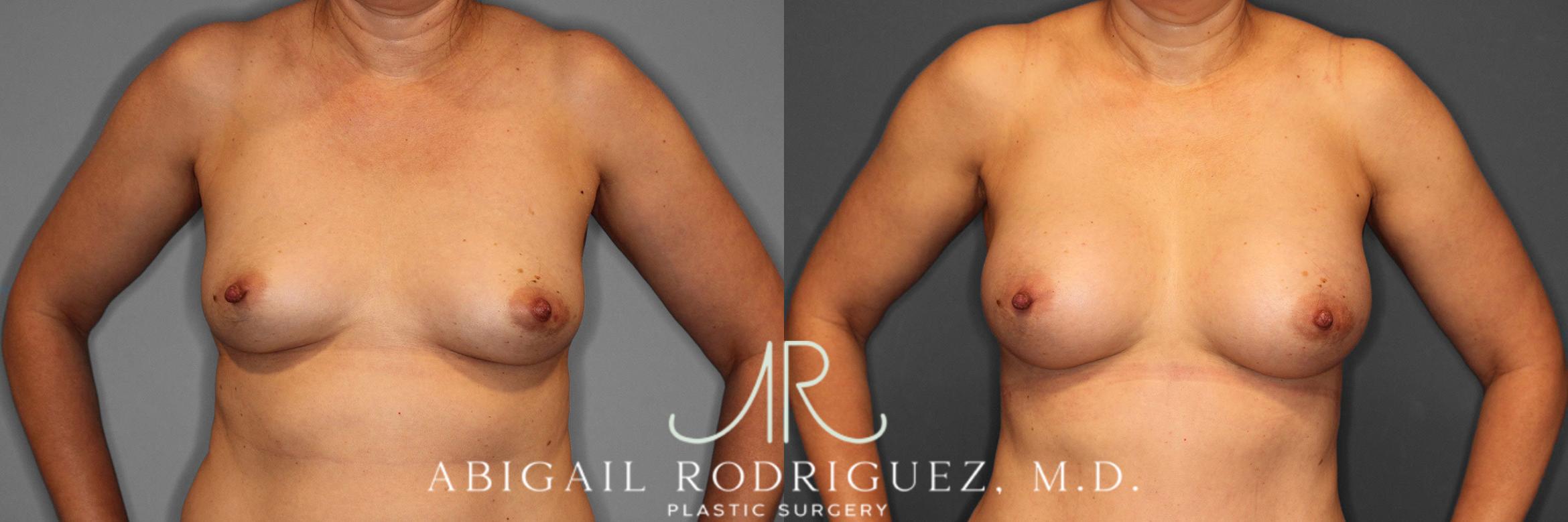 Before & After Breast Augmentation Case 258508 View 2 View in Houston, TX