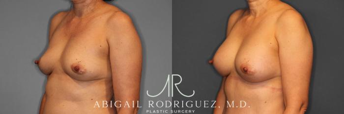 Before & After Breast Augmentation Case 258508 View 3 View in Houston, TX
