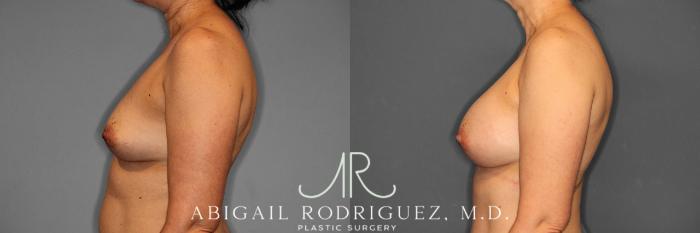 Before & After Breast Augmentation Case 258508 View 4 View in Houston, TX