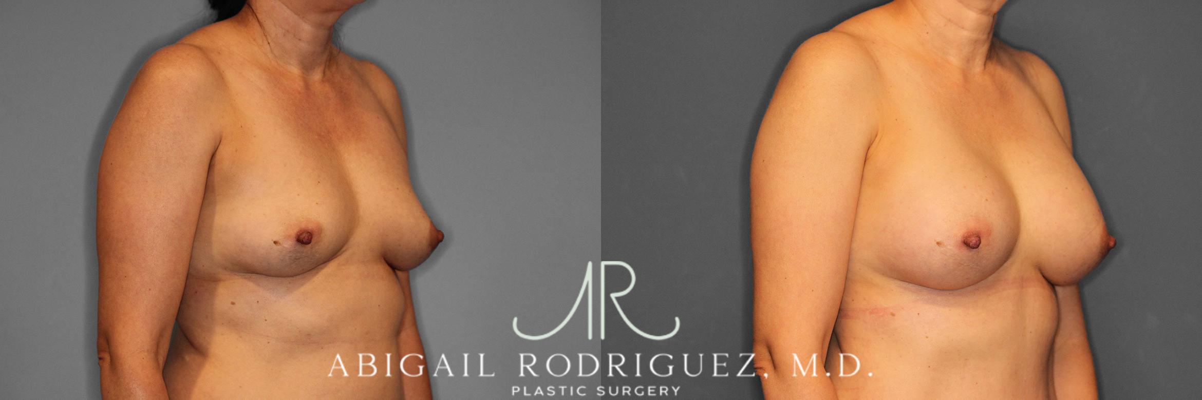 Before & After Breast Augmentation Case 258508 View 5 View in Houston, TX