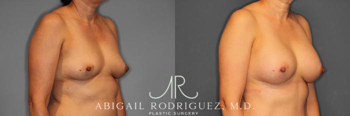 Before & After Breast Augmentation Case 258508 View 5 View in Houston, TX