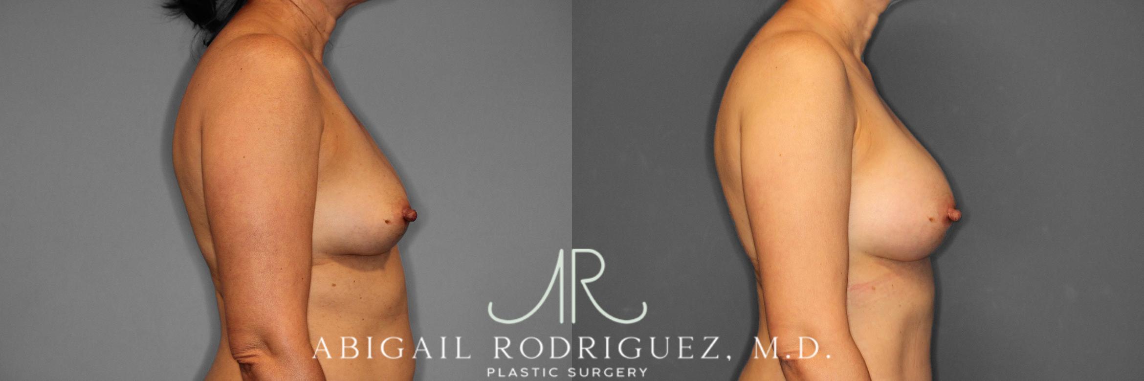 Before & After Breast Augmentation Case 258508 View 6 View in Houston, TX