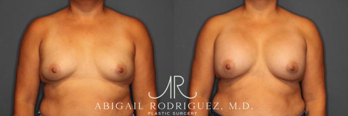 Before & After Breast Augmentation Case 258552 View 1 View in Houston, TX