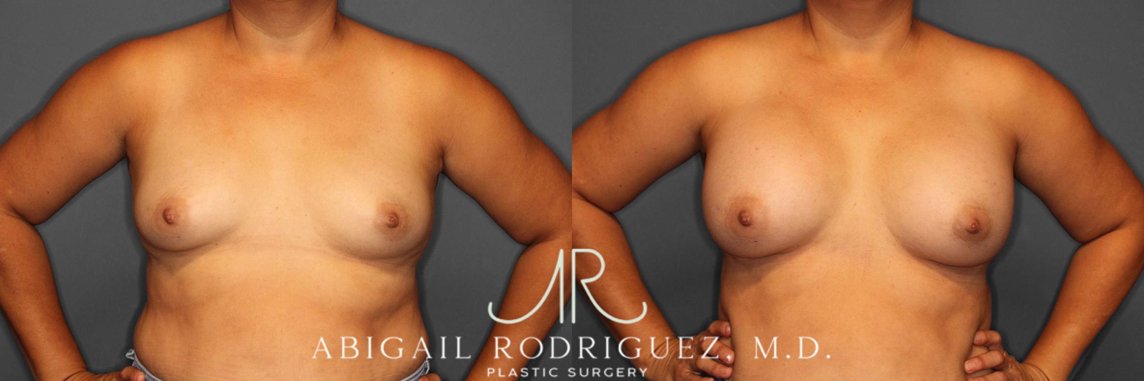 Before & After Breast Augmentation Case 258552 View 2 View in Houston, TX
