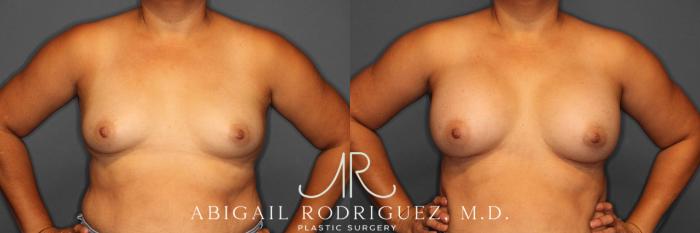 Before & After Breast Augmentation Case 258552 View 2 View in Houston, TX