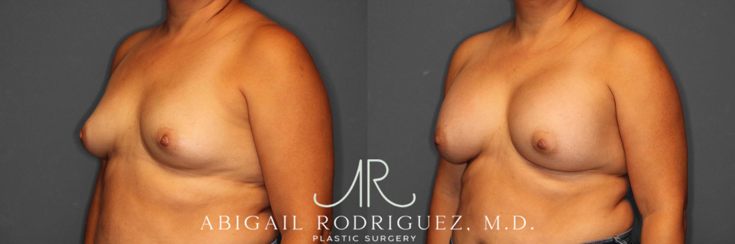 Before & After Breast Augmentation Case 258552 View 3 View in Houston, TX