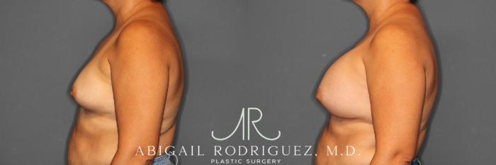 Before & After Breast Augmentation Case 258552 View 4 View in Houston, TX