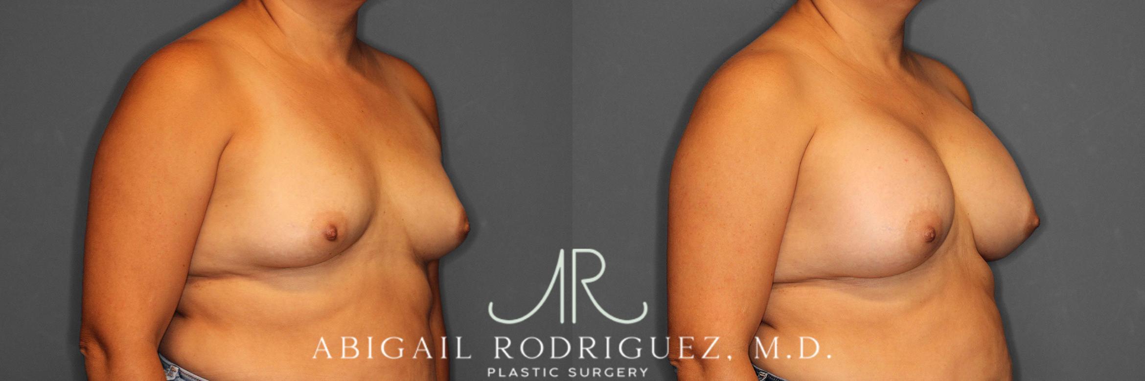 Before & After Breast Augmentation Case 258552 View 5 View in Houston, TX