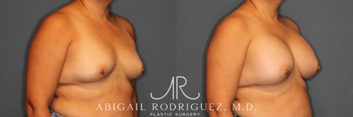 Before & After Breast Augmentation Case 258552 View 5 View in Houston, TX