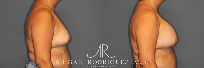 Before & After Breast Augmentation Case 258552 View 6 View in Houston, TX