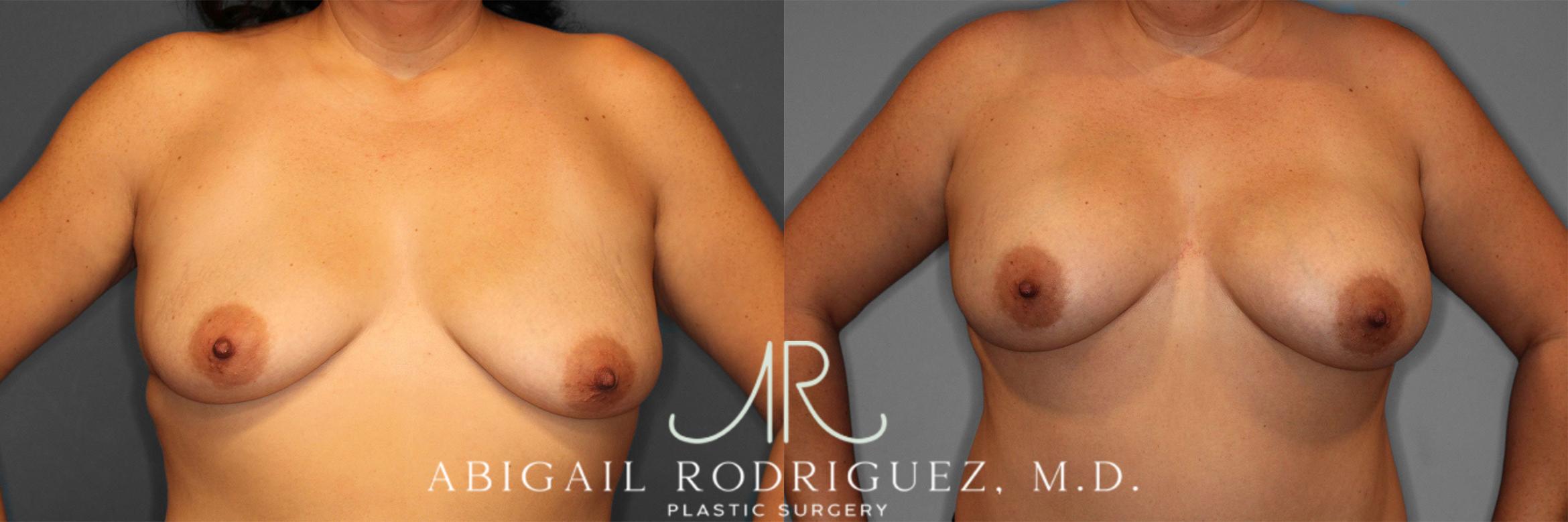 Before & After Breast Augmentation Case 258584 View 1 View in Houston, TX