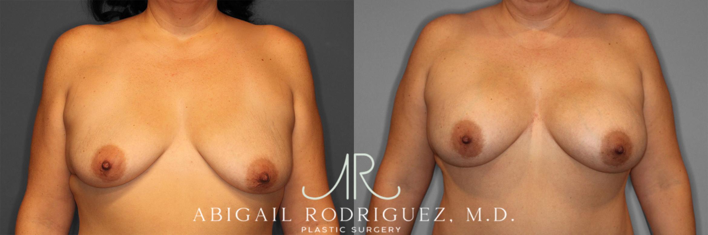 Before & After Breast Augmentation Case 258584 View 2 View in Houston, TX
