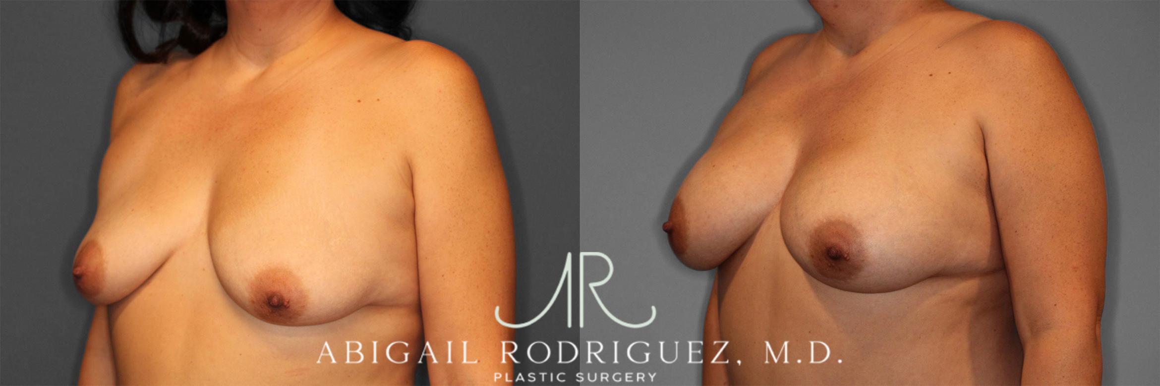 Before & After Breast Augmentation Case 258584 View 3 View in Houston, TX