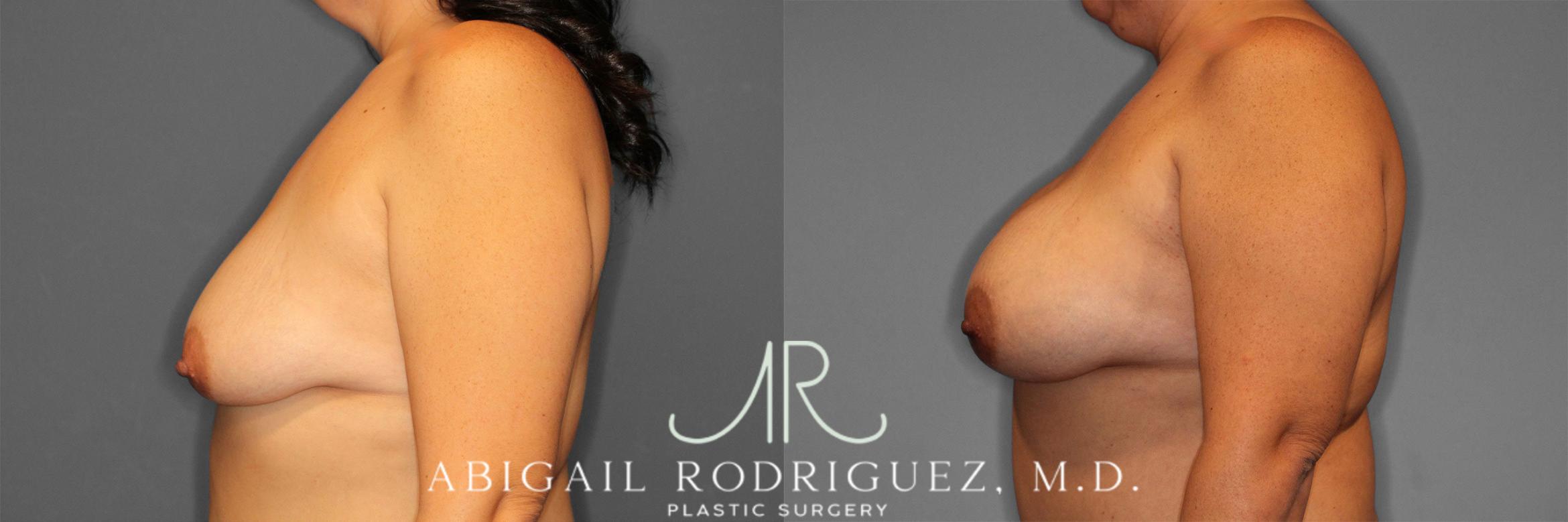Before & After Breast Augmentation Case 258584 View 4 View in Houston, TX