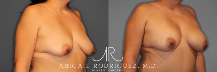 Before & After Breast Augmentation Case 258584 View 5 View in Houston, TX