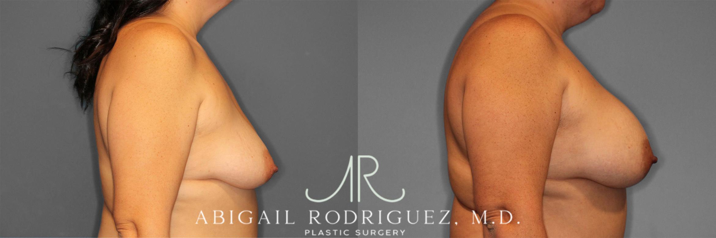 Before & After Breast Augmentation Case 258584 View 6 View in Houston, TX