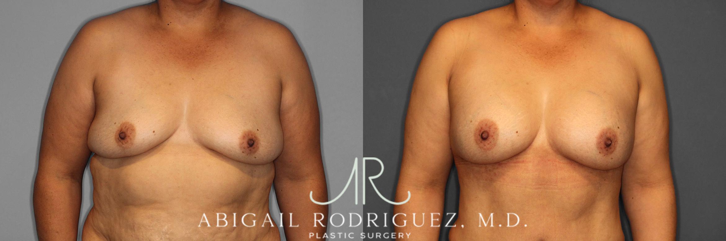 Before & After Breast Augmentation Case 258613 View 1 View in Houston, TX
