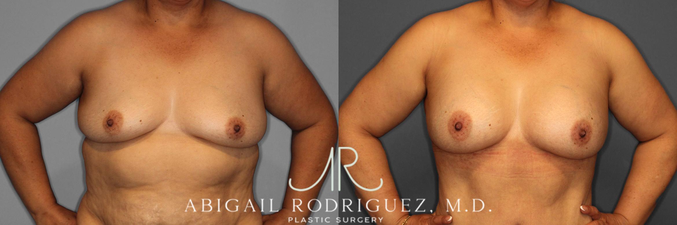 Before & After Breast Augmentation Case 258613 View 2 View in Houston, TX