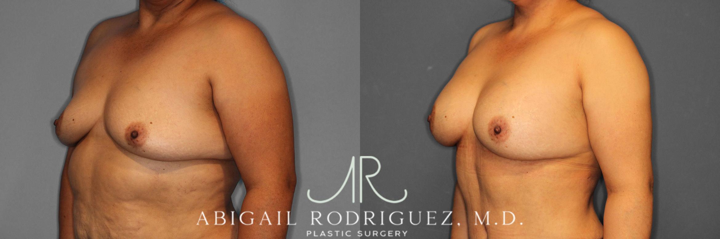 Before & After Breast Augmentation Case 258613 View 3 View in Houston, TX