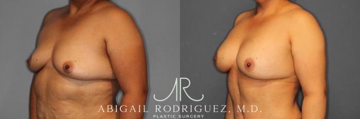 Before & After Breast Augmentation Case 258613 View 3 View in Houston, TX