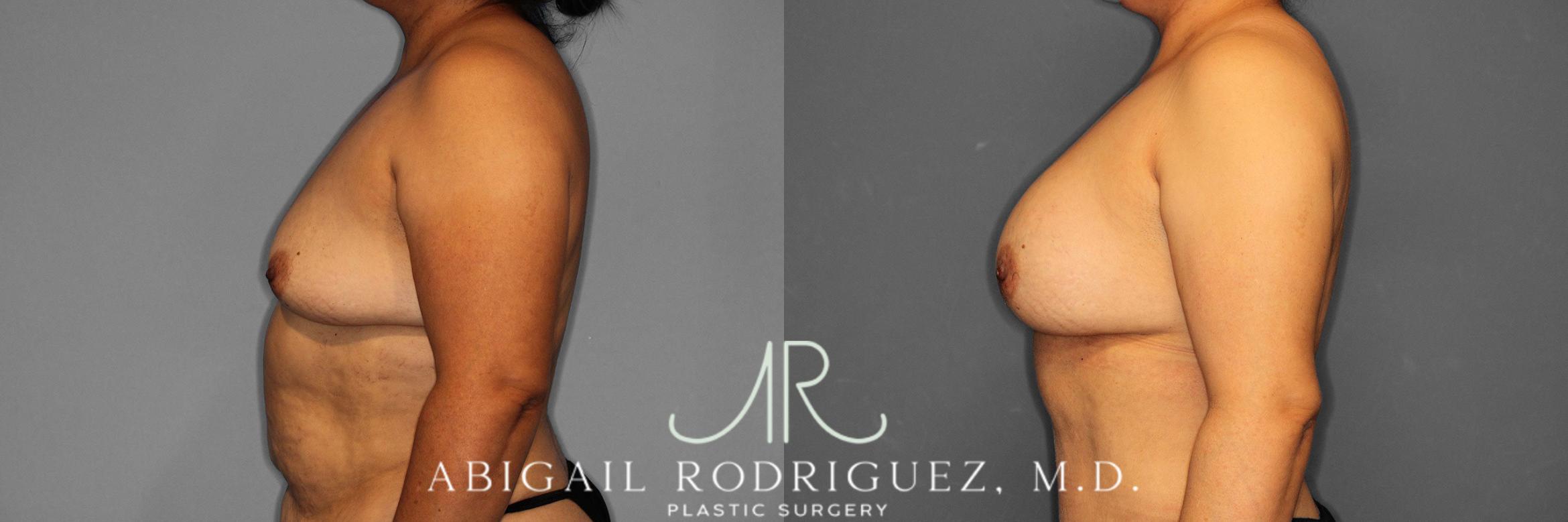 Before & After Breast Augmentation Case 258613 View 4 View in Houston, TX