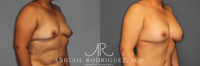 Before & After Breast Augmentation Case 258613 View 5 View in Houston, TX
