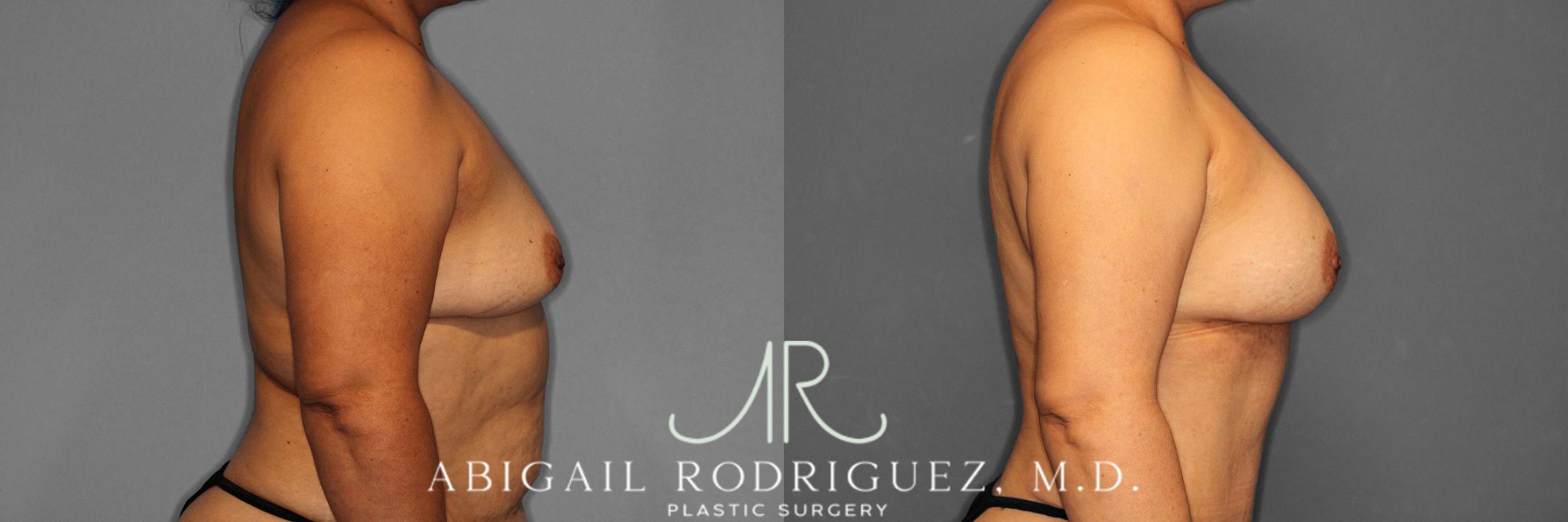 Before & After Breast Augmentation Case 258613 View 6 View in Houston, TX