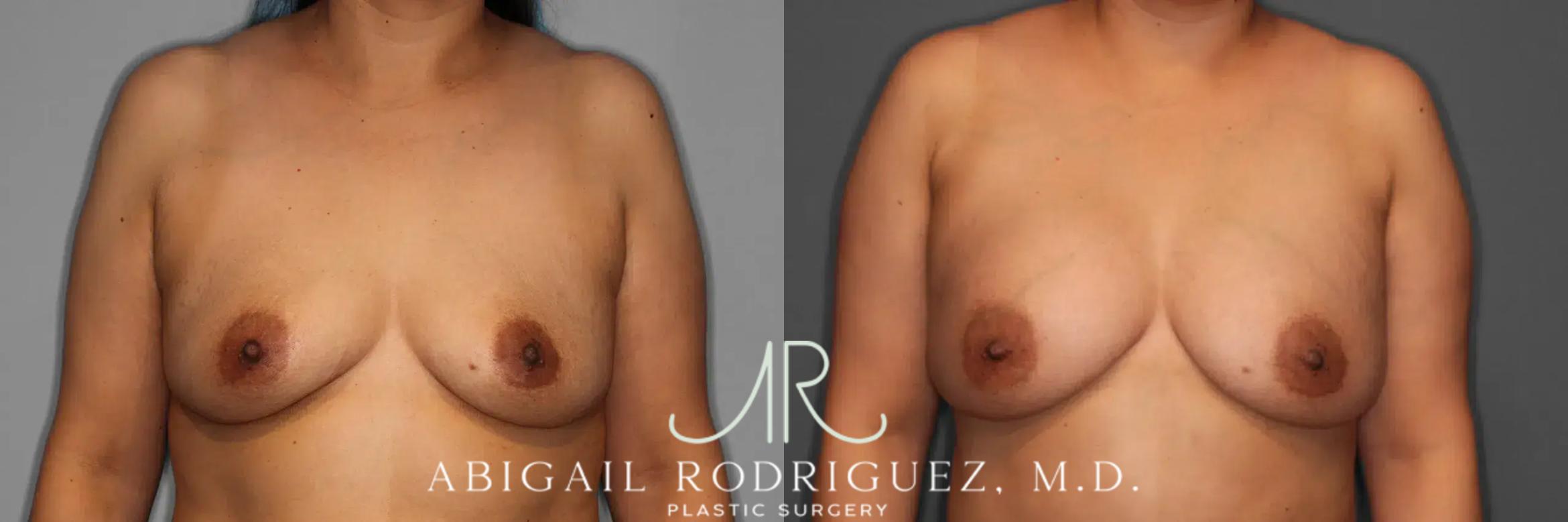Before & After Breast Augmentation Case 259123 View 1 View in Houston, TX