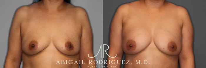 Before & After Breast Augmentation Case 259123 View 1 View in Houston, TX