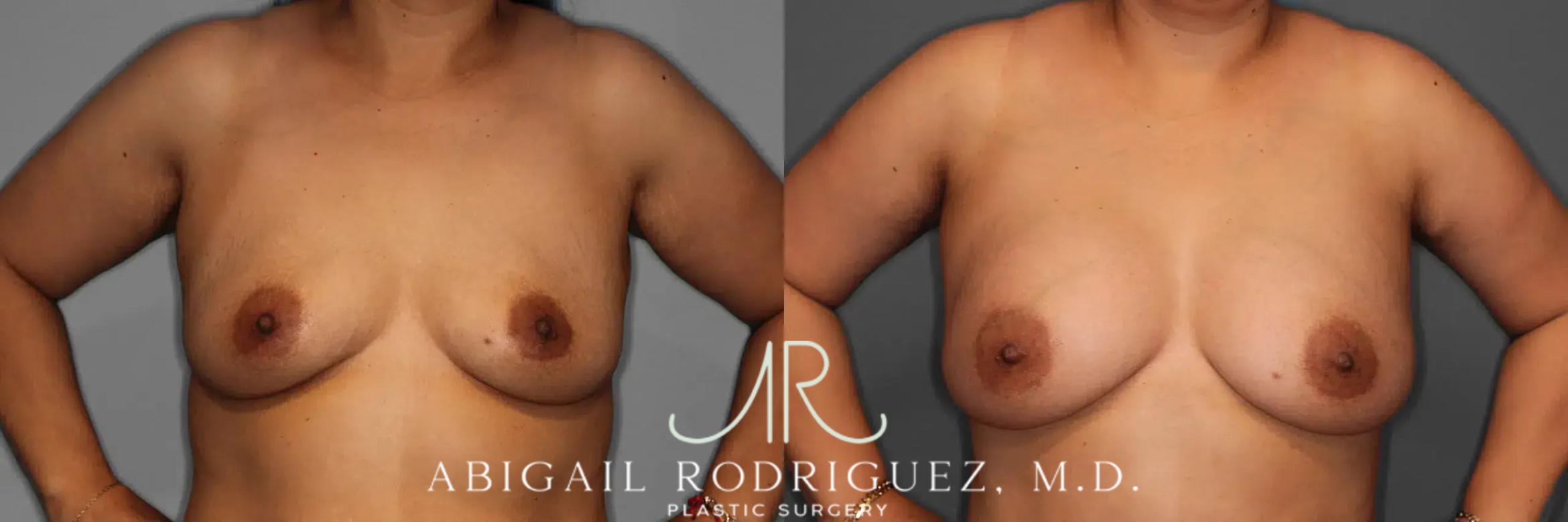 Before & After Breast Augmentation Case 259123 View 2 View in Houston, TX