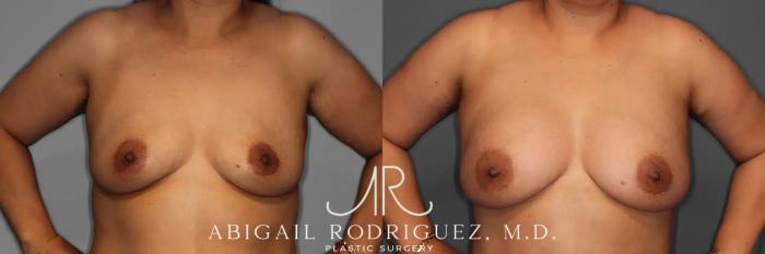 Before & After Breast Augmentation Case 259123 View 2 View in Houston, TX