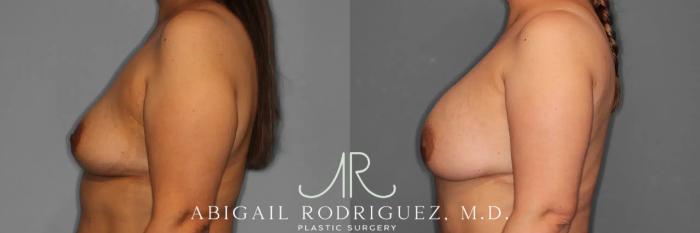 Before & After Breast Augmentation Case 259123 View 4 View in Houston, TX