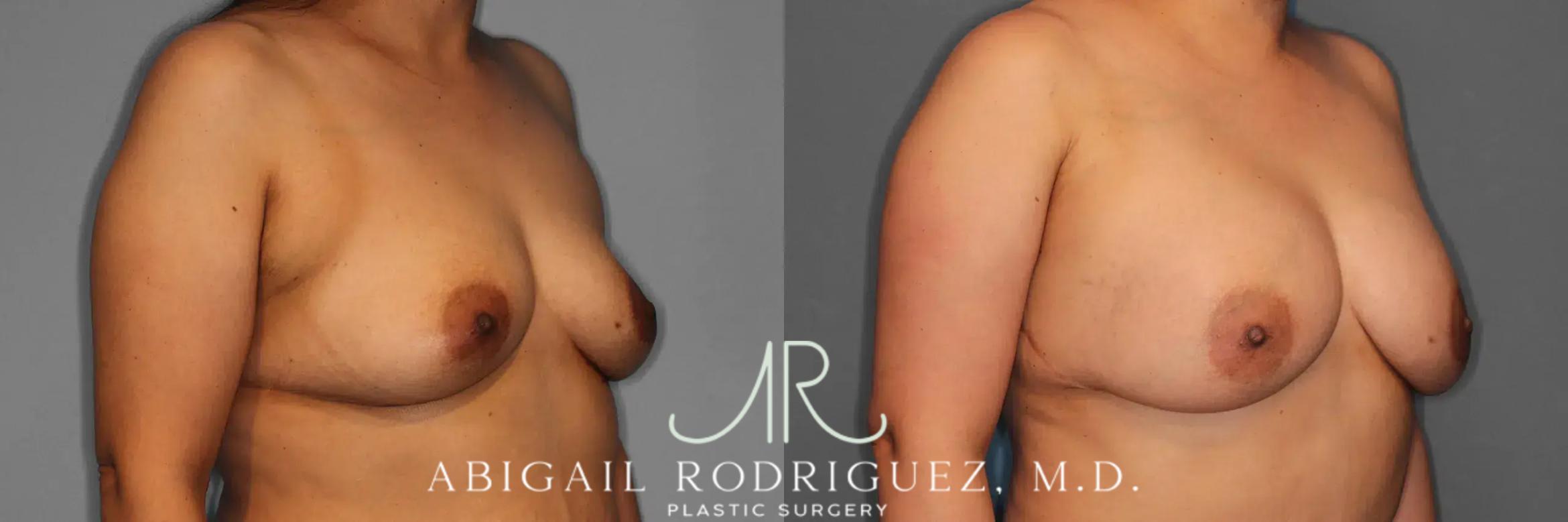 Before & After Breast Augmentation Case 259123 View 5 View in Houston, TX