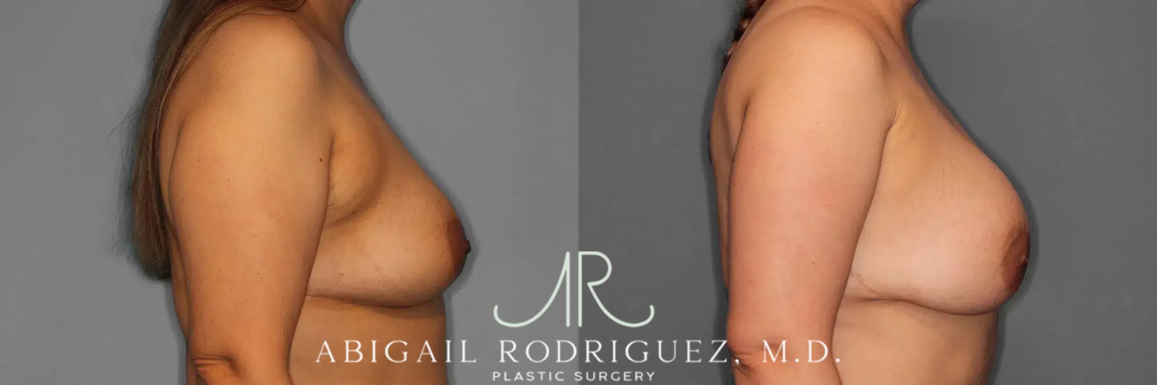 Before & After Breast Augmentation Case 259123 View 6 View in Houston, TX