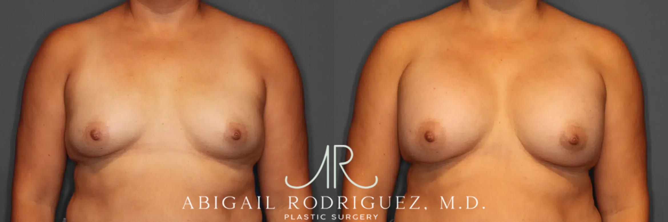 Before & After Breast Augmentation Case 259317 View 1 View in Houston, TX