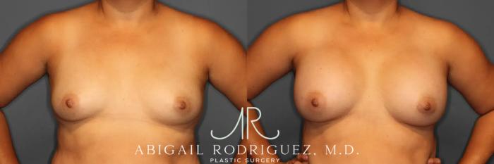 Before & After Breast Augmentation Case 259317 View 2 View in Houston, TX