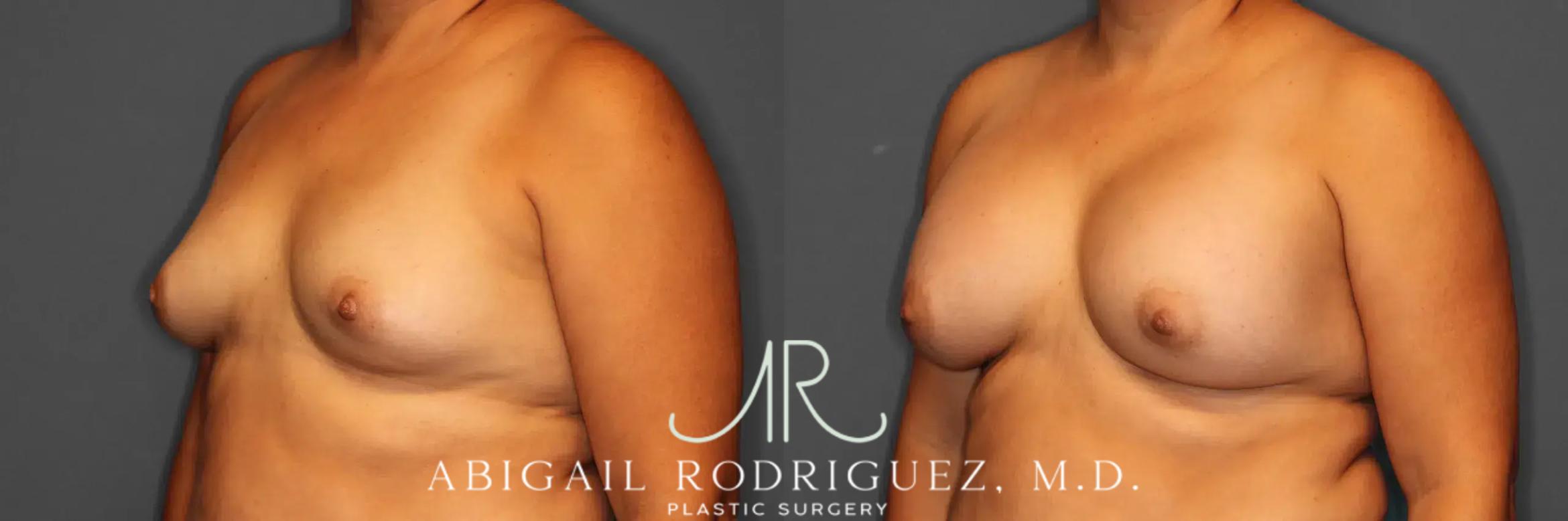 Before & After Breast Augmentation Case 259317 View 3 View in Houston, TX