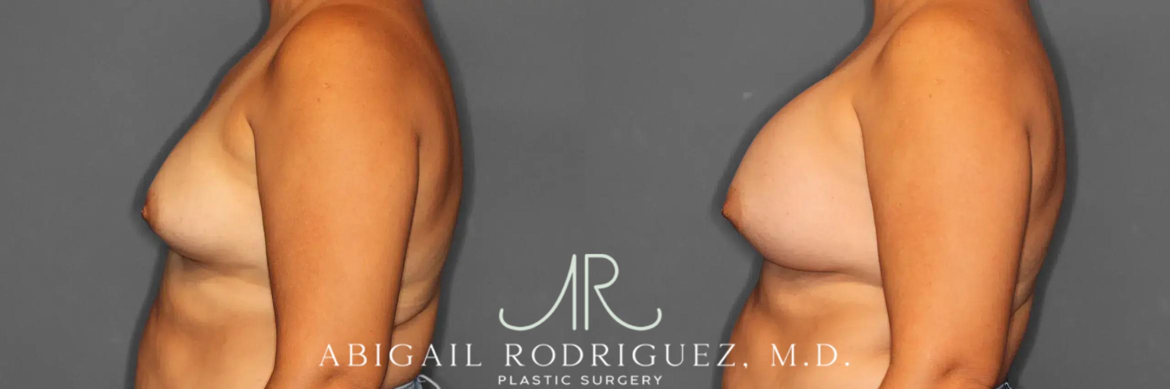 Before & After Breast Augmentation Case 259317 View 4 View in Houston, TX