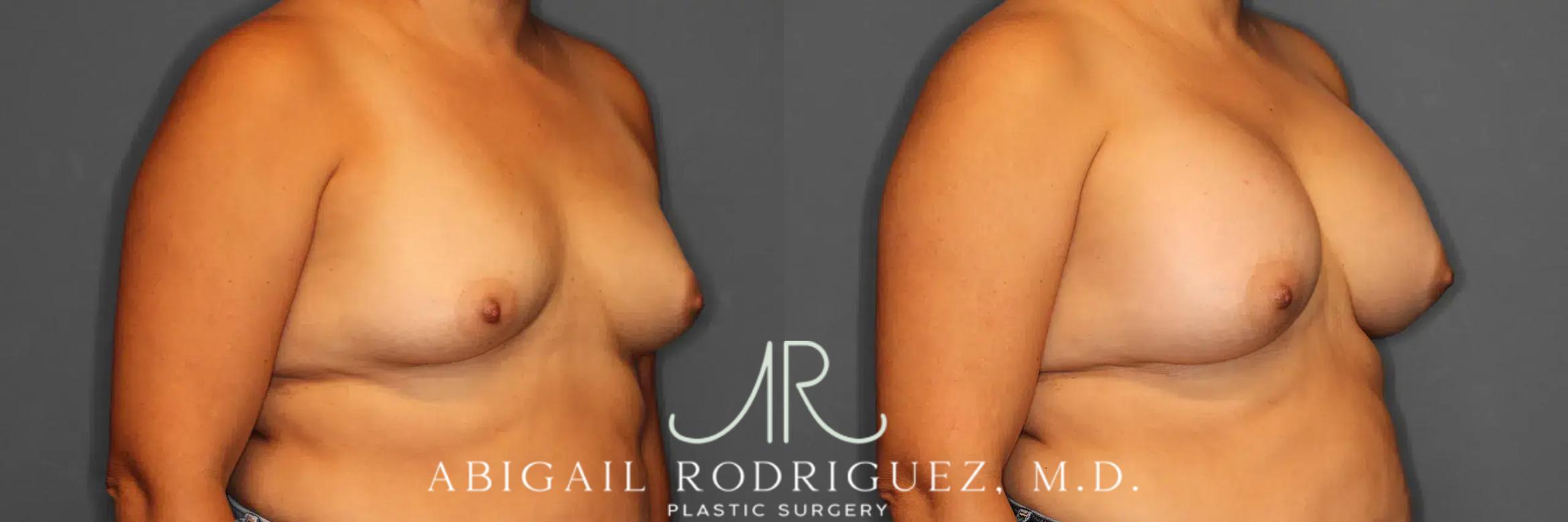 Before & After Breast Augmentation Case 259317 View 5 View in Houston, TX